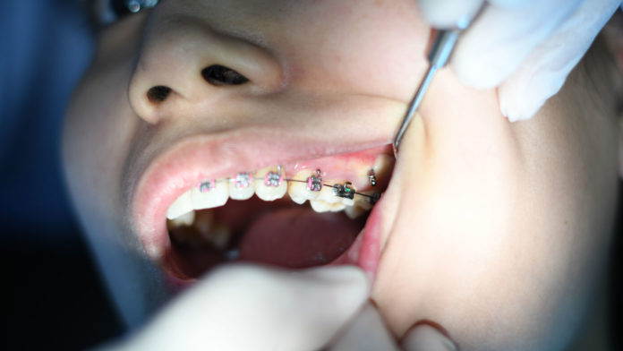 Now-It's-Proper-Time-to-Straighten-Your-Teeth-on-civicdaily